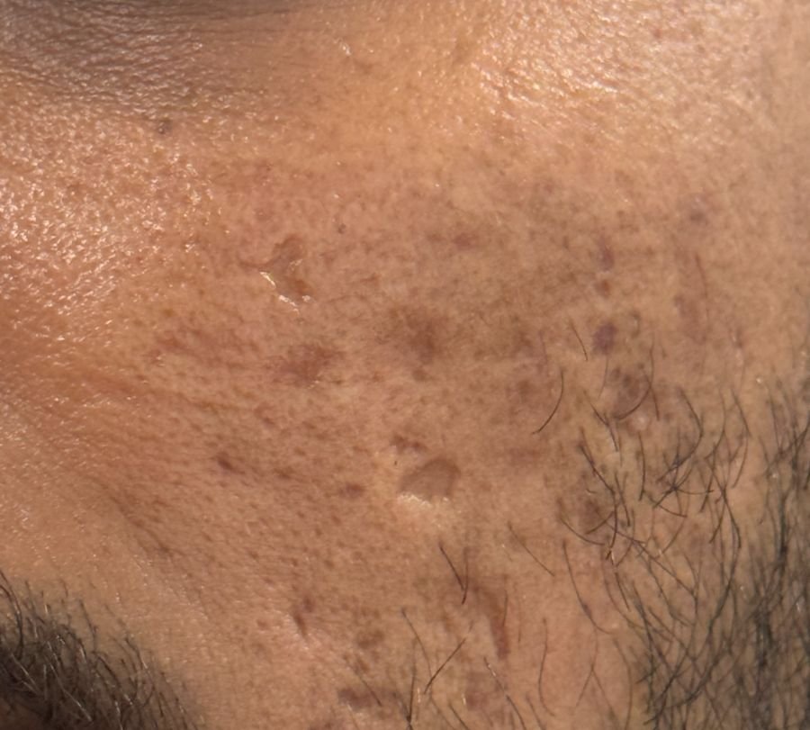 Boxcar acne scars on the cheek with defined edges