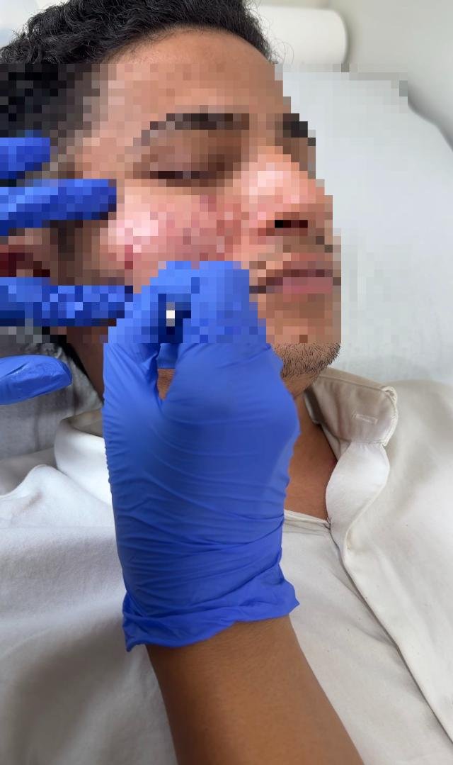 Comedone extraction for active acne at Linaé Clinic