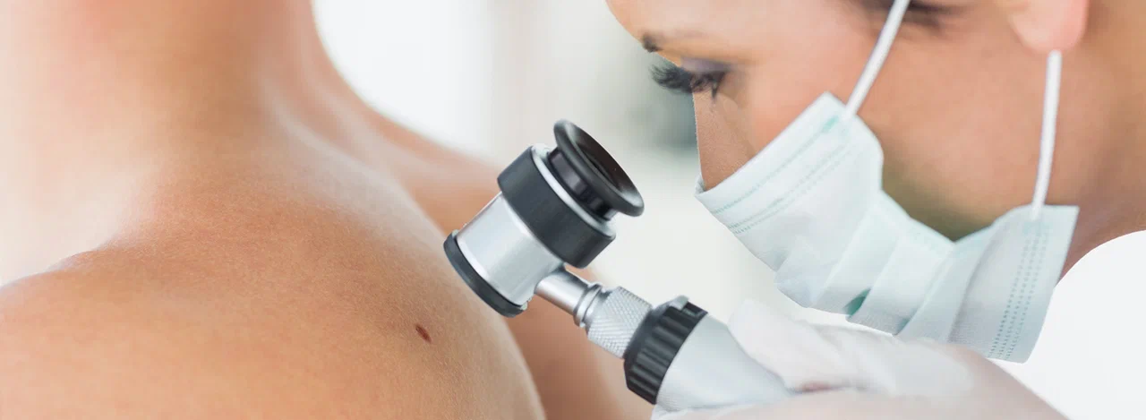 Dermatoscope examination of a mole on the shoulder