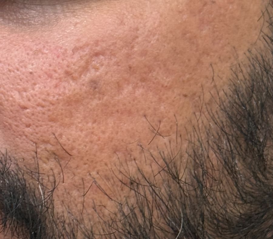 Enlarged pores and uneven skin texture on the cheek