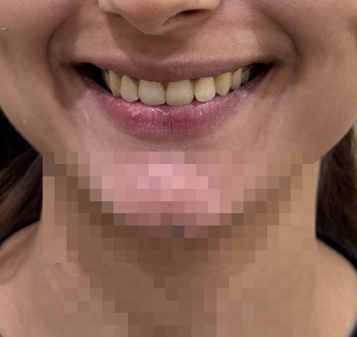 Gummy smile corrected with botulinum toxin, 4 weeks after treatment at Linaé Clinic Hyderabad