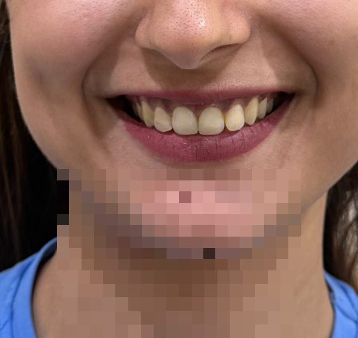 Gummy smile before botulinum toxin treatment