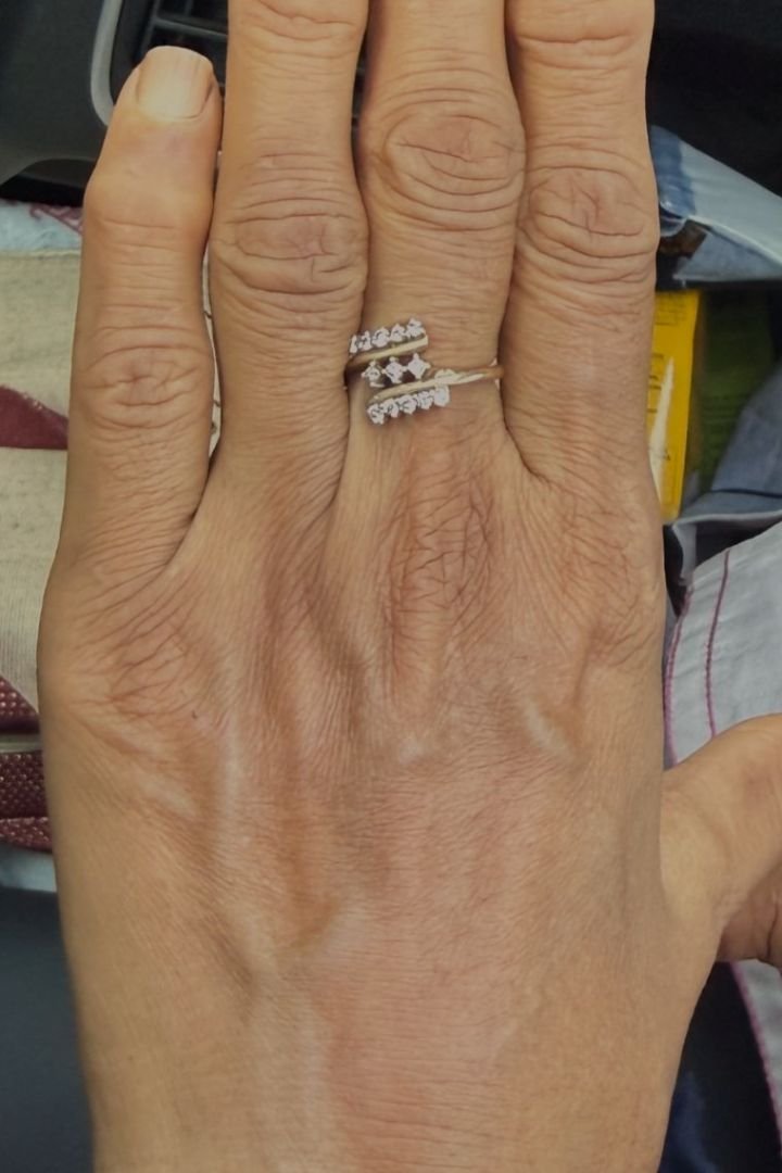 Hand rejuvenation with skin boosters, after 8 weeks, at Linaé Clinic Hyderabad
