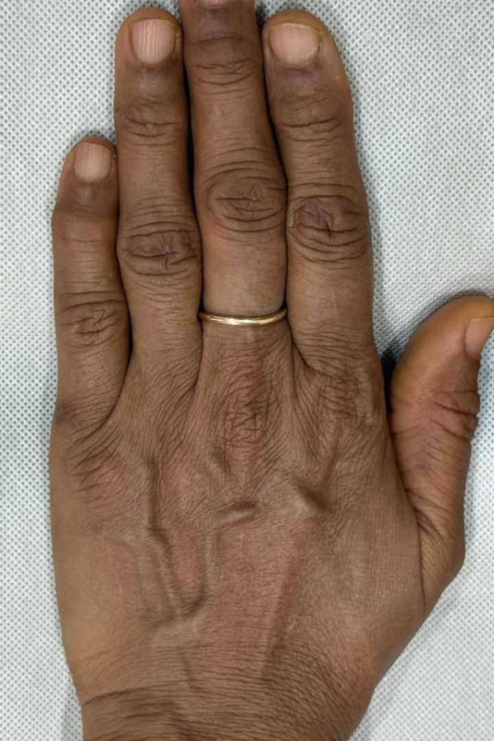 Hand before skin booster treatment