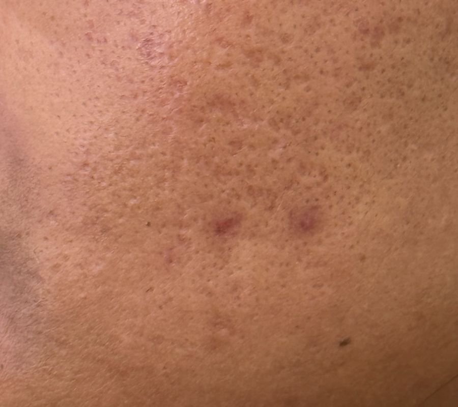 Narrow, deep ice pick acne scarring on the cheek
