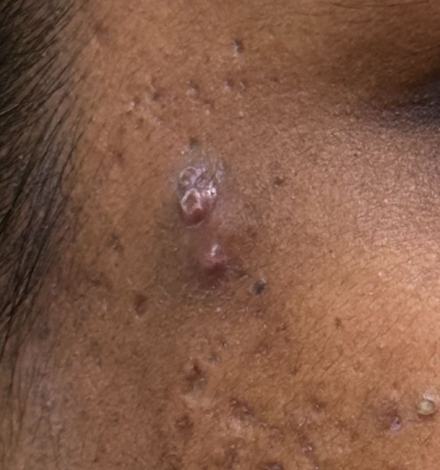 Raised keloidal acne scar on the upper cheek