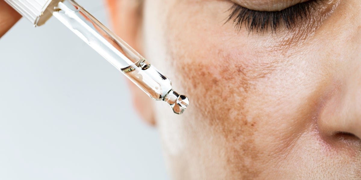 Close-up of brown pigmentation patches on the cheek