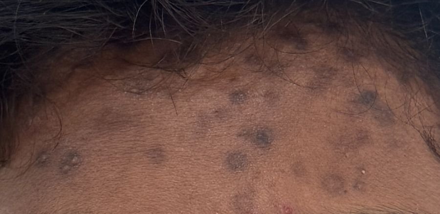 Flat post-inflammatory marks left after acne on the forehead