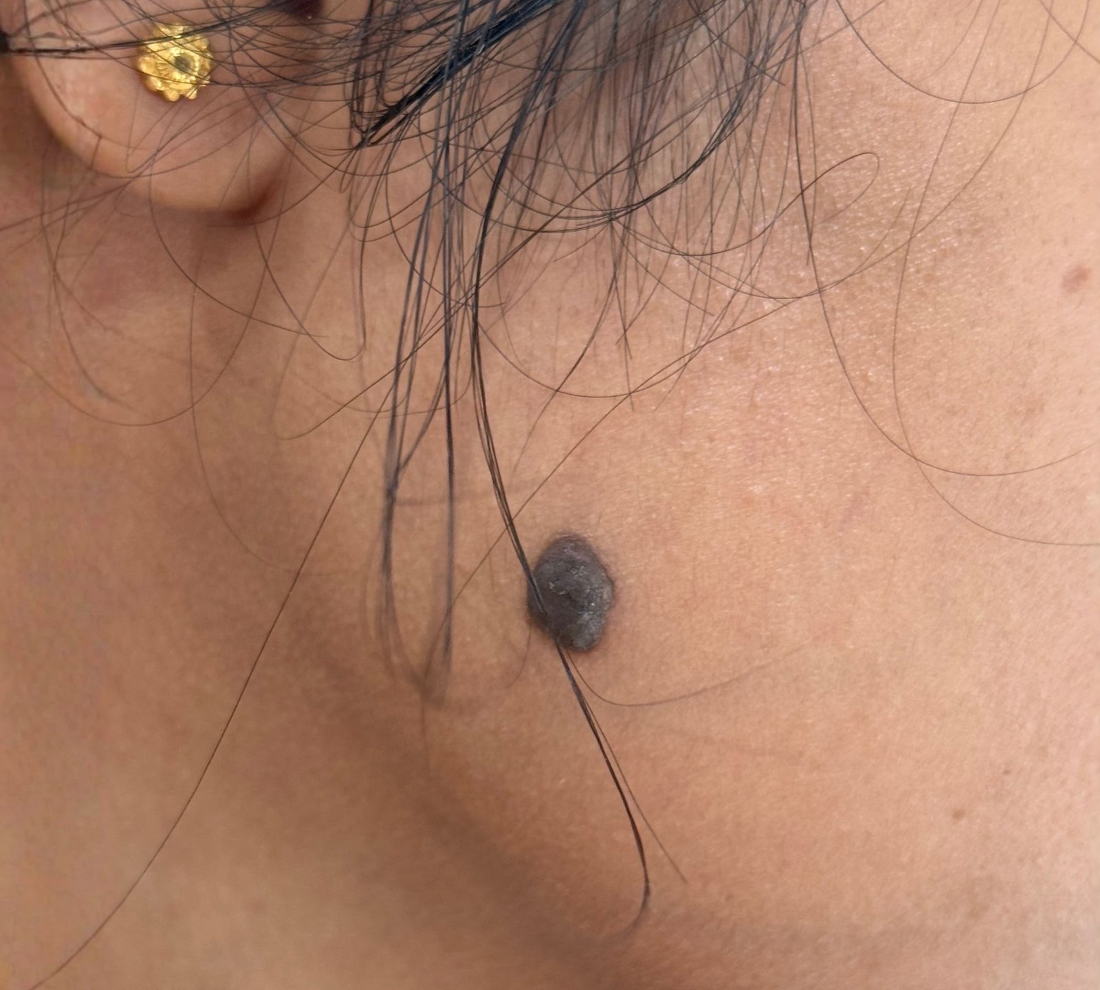 Before acne treatment