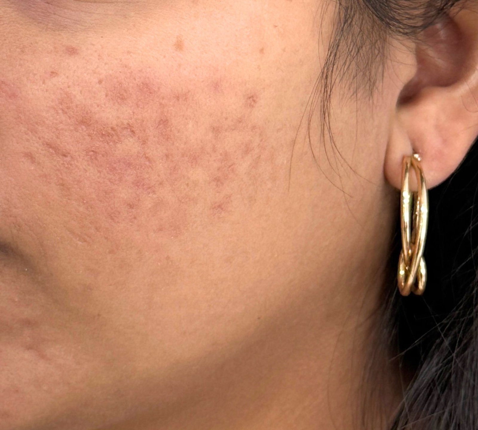 After acne scar treatment
