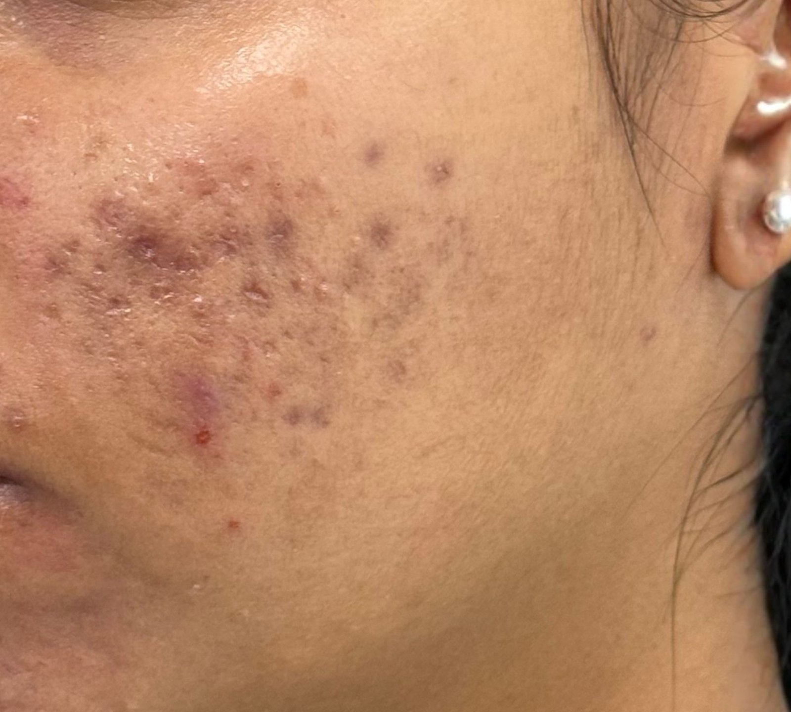 Before acne scar treatment