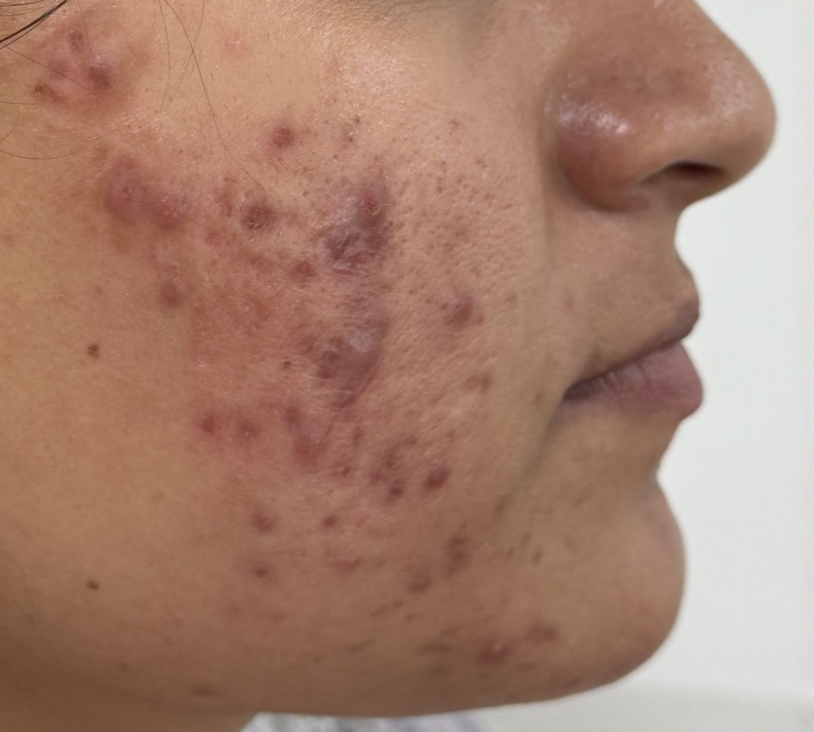 Before post-acne texture treatment