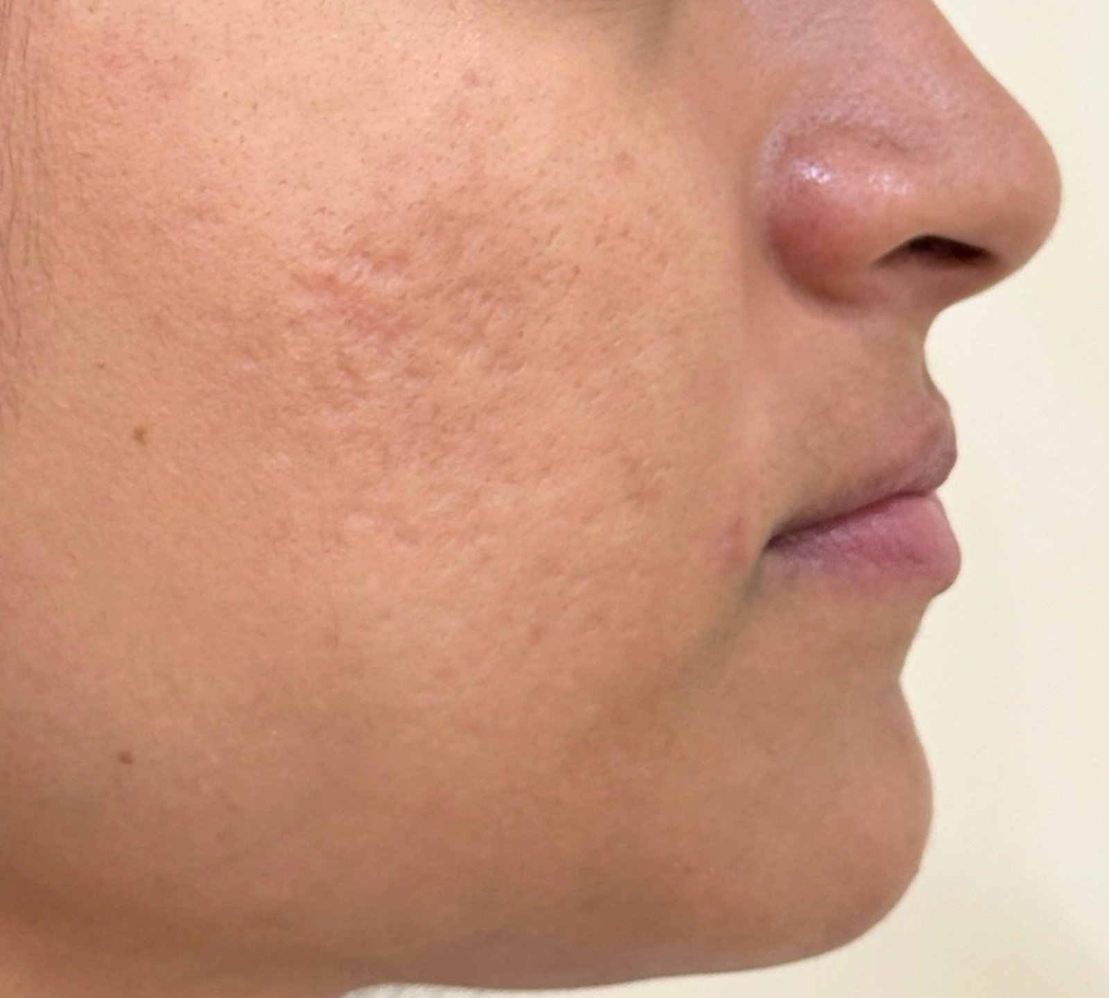 After post-acne texture treatment