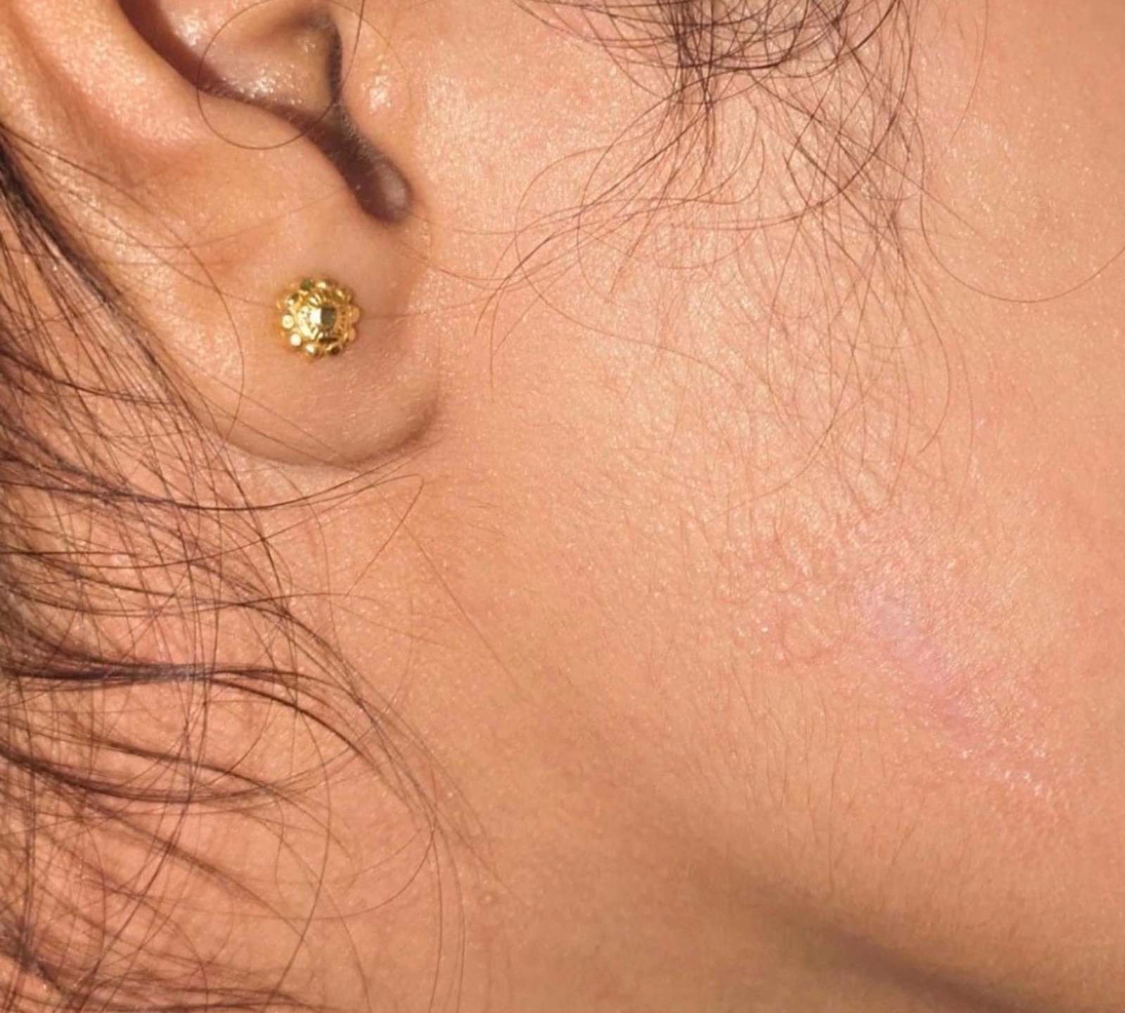 After acne treatment