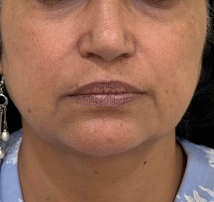 Mid-face RF skin tightening result after 8 sessions at Linaé Clinic Hyderabad