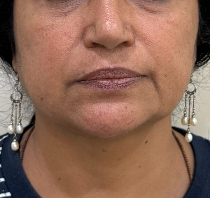 Mid-face before RF skin tightening