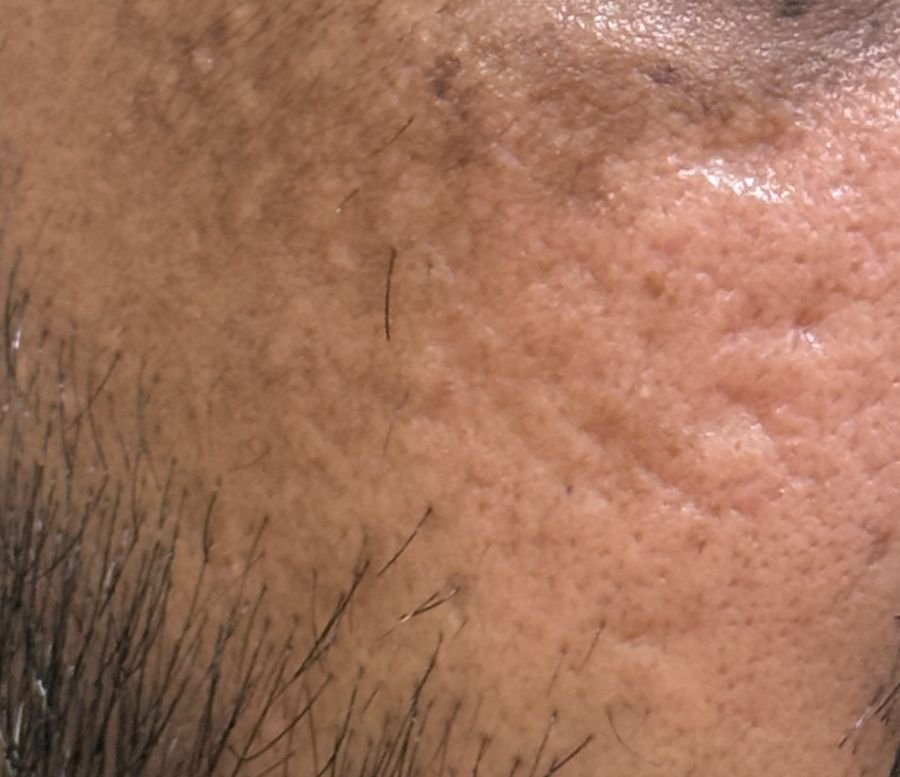 Rolling acne scars on the cheek: broad, shallow, undulating depressions