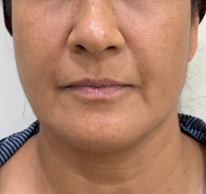 Skin booster result showing improved skin quality at Linaé Clinic Hyderabad