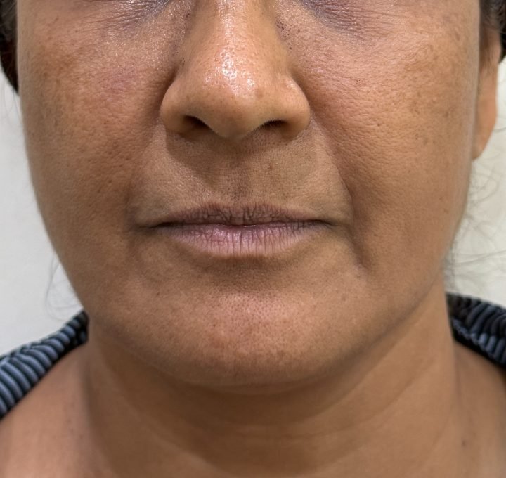 Face before skin booster treatment