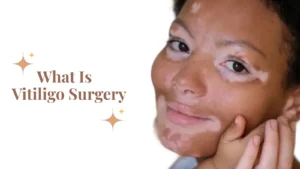 What Is Vitiligo Surgery, And Are You Actually a Candidate?