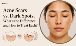 Acne Scars vs. Dark Spots, You Are Probably Treating the Wrong One