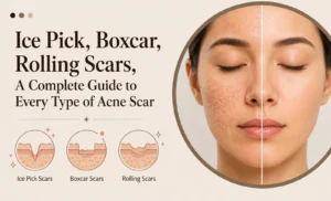 Ice Pick, Boxcar, Rolling Scars, A Complete Guide to Every Type of Acne Scar